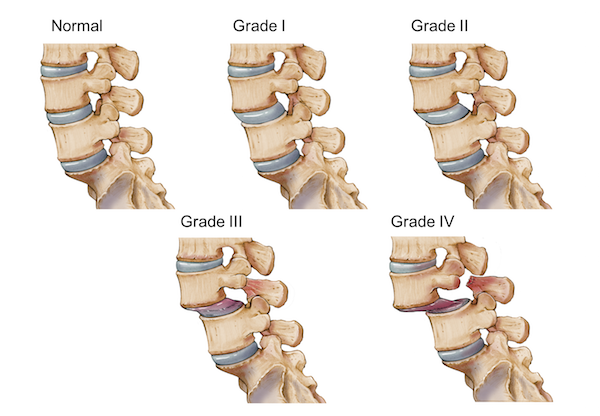 Wirbelgleiten Meyerding Grad 2 Gdb pathologies.lexmedicus.com.au